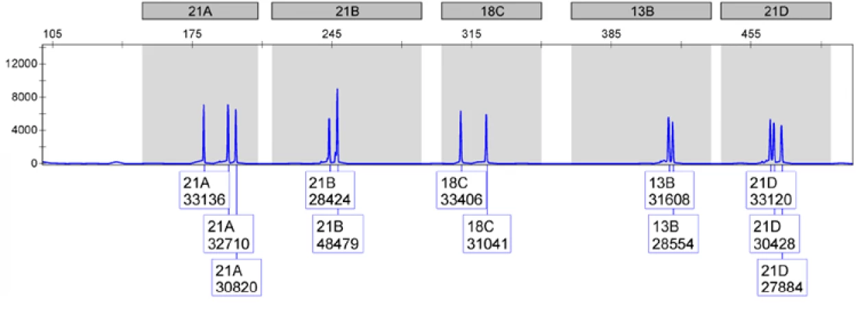 Alteração no número de cópias do cromossoma 21 (trissomia) compatível com Síndrome de Down.
